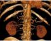 Imagen B2. Reconstrucción volumétrica de las principales arterias del abdomen superior. 1: tronco celíaco; 2: arteria gástrica izquierda; 3: arteria hepática común; 4: arteria esplénica; 5: arteria mesentérica superior.(3)